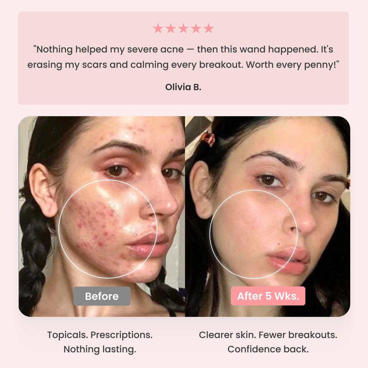 DermaPRO 2.0 - High Frequency Wand
