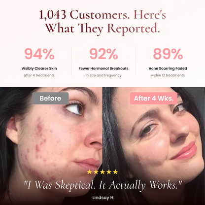 DermaPRO 2.0 - High Frequency Wand