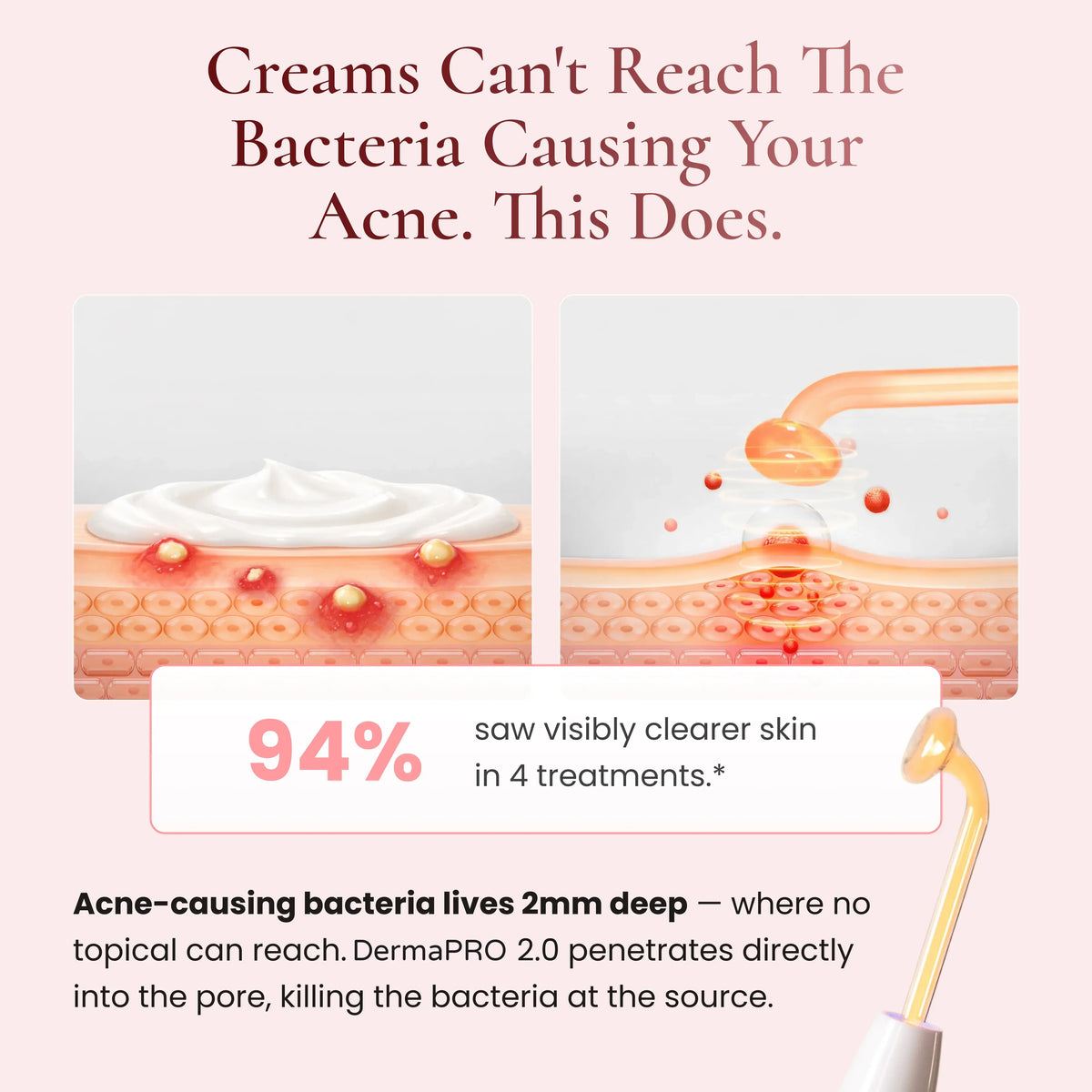 DermaPRO 2.0 - High Frequency Wand